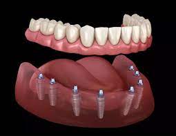 all on 8 implant