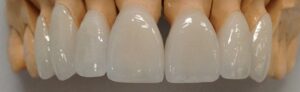 Porcelain Zirconia Ceramic CAD CAM Metal Free Dental Crowns, Teeth Cap Treatment at Dental Crown Dentist Dental Clinic in Geeta Colony, East Delhi.