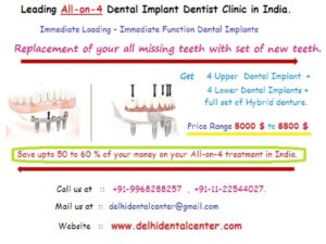 All on 4 Dental Implants in East delhi