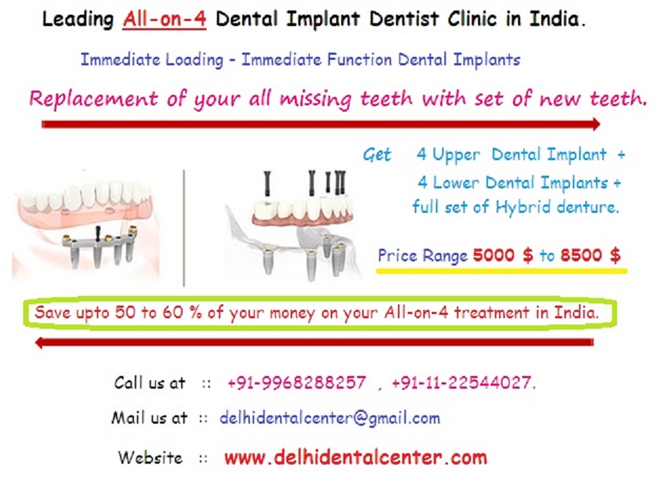 All on 4 Dental Implants in East delhi