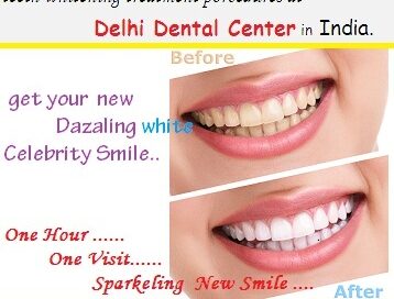 Tooth Whitening Delhi.