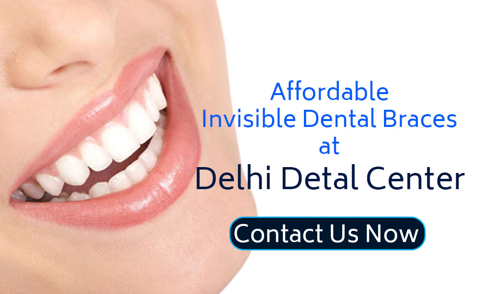 Dental Braces Delhi