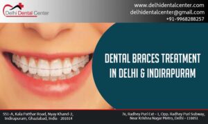 Dental Braces Treatment in Laxmi Nagar