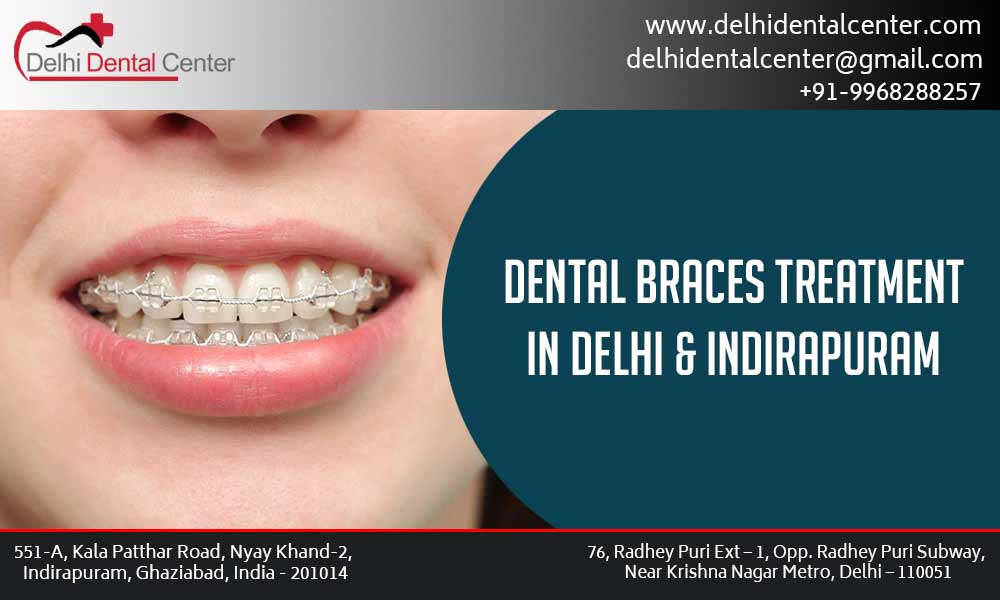 Dental Braces Dental Clinic in Laxmi Nagar
