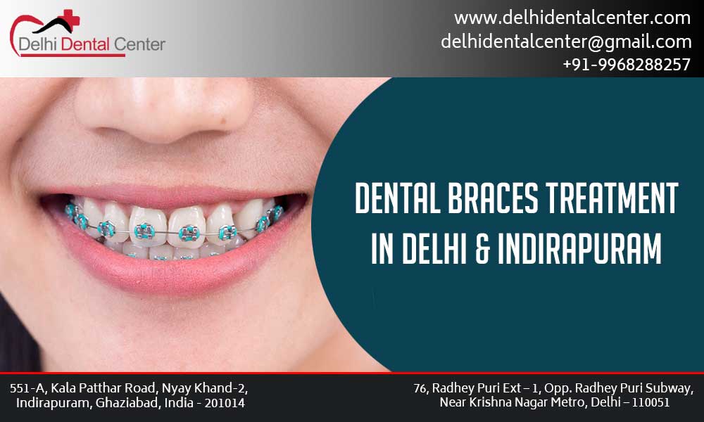 Dental Braces Clinic in Laxmi Nagar