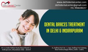 Dental Braces in East delhi