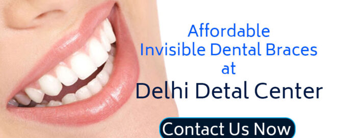 Dental Braces Treatment in Delhi