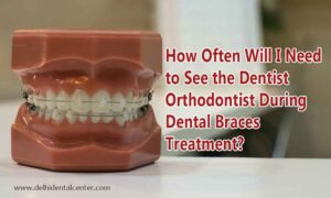 Dental Braces Dental Clinic in Delhi