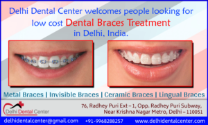 Dental Braces Dentist in Delhi
