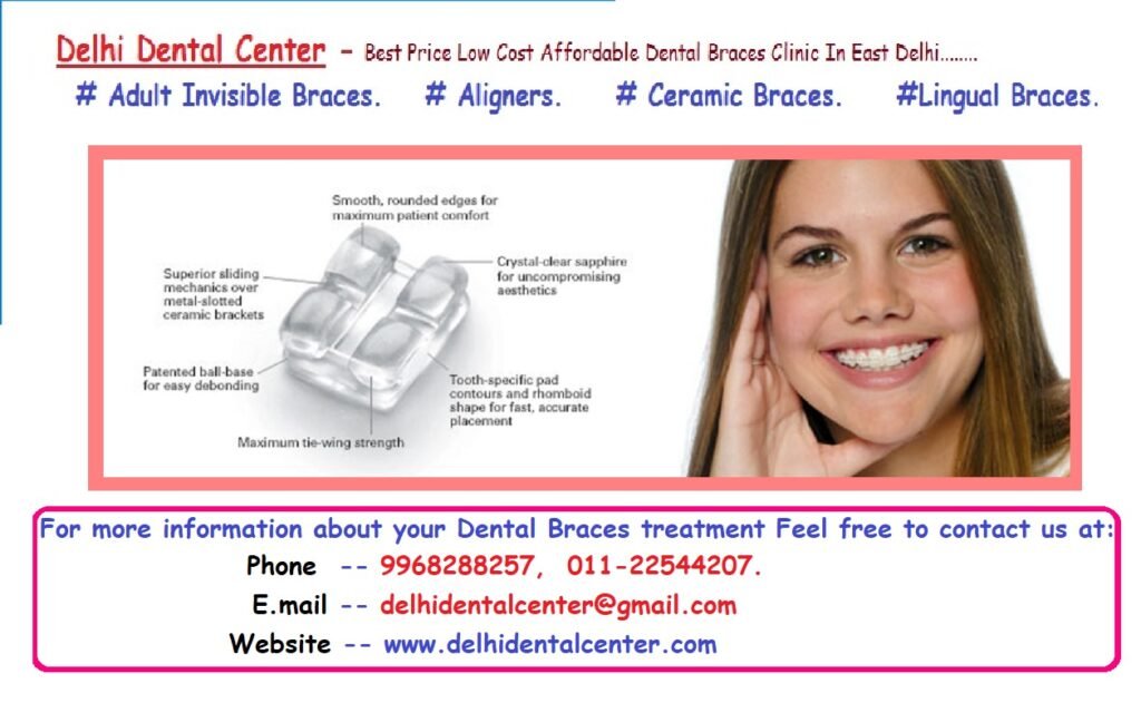 Dental Aligners Treatment in Vishwas Nagar.