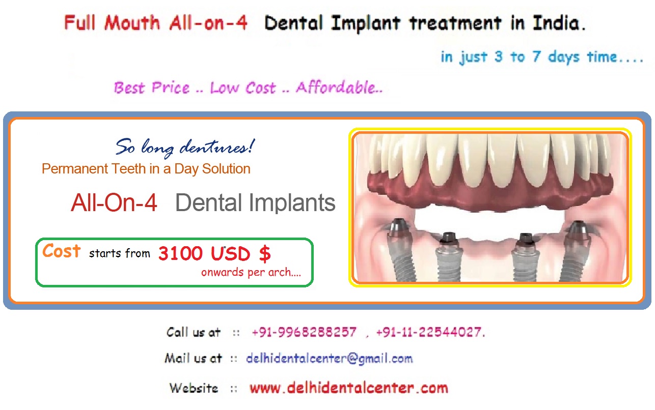 All on 4 Dental Implants in Mayur Vihar