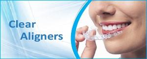 clear Aligners