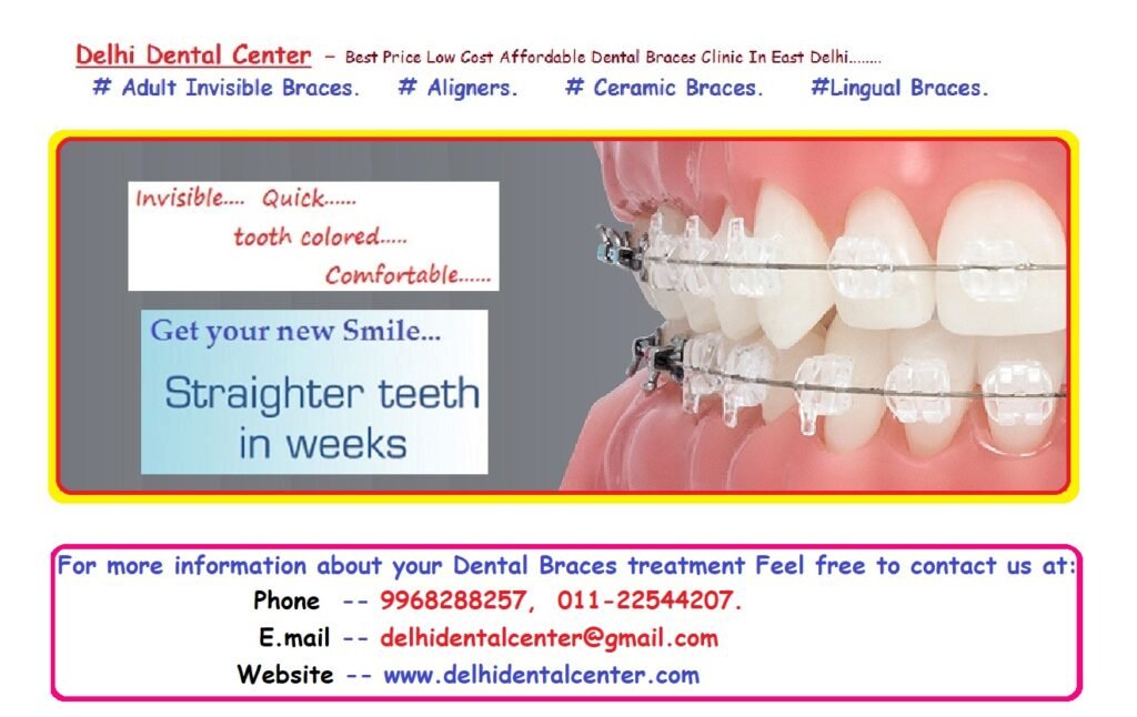 Tooth Coloured Dental Braces Treatment in East Delhi