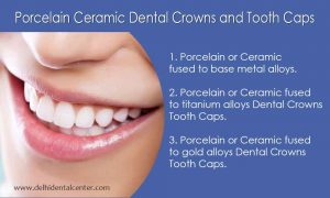 Dental Crown Delhi