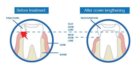 Crown Lengthening in Delhi