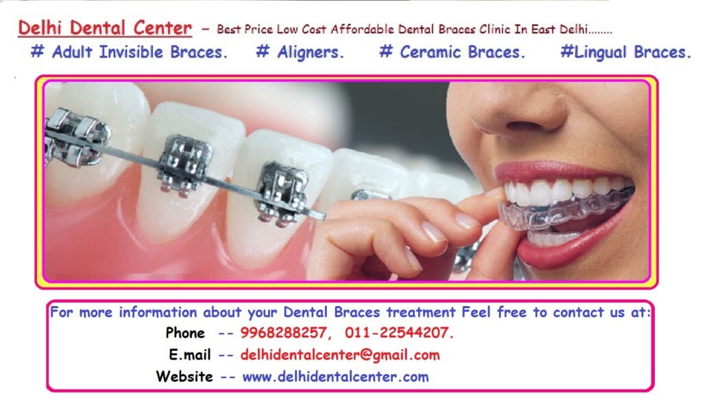 Dental Braces Treatment in Pandav Nagar