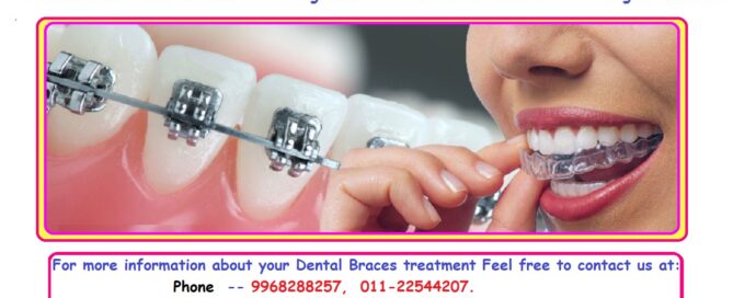 Dental Braces Treatment in Pandav Nagar