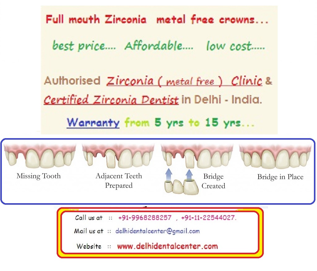 Porcelain Zirconia Ceramic CAD CAM Metal Free Dental Crowns, Teeth Cap Treatment at Dental Crown Dentist Dental Clinic in Dilshad Garden, East Delhi.
