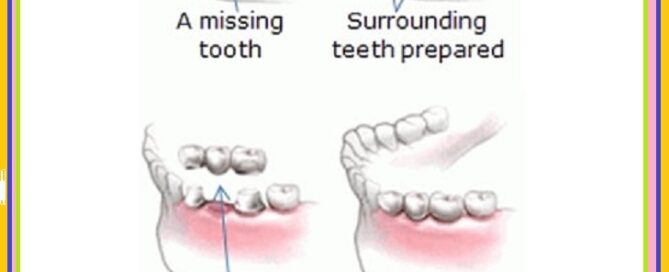 Best price, Low Cost, Cheapest, Teeth in an Hour, Same Day Immediate Porcelain Zirconia Ceramic CAD CAM Metal Free Dental Crowns, Teeth Cap Treatment at Dental Crown Dentist Dental Clinic in Radhey Puri, East Delhi.