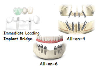 Dental Implants