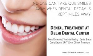 All on 4 Dental Implants Delhi