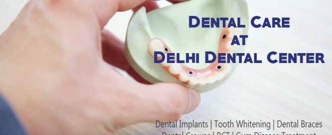 Dental Implant Delhi