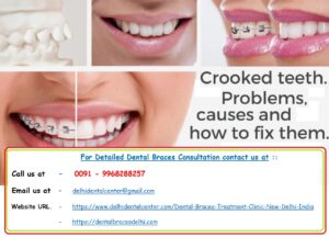 Top Best Adult Invisible Tooth Colored Ceramic Orthodontic Dental Braces Aligners, Retainers, Expansion Plates, Treatment in East Delhi.