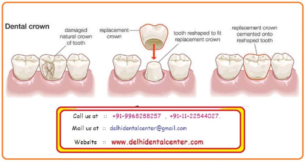 Porcelain Zirconia Ceramic CAD CAM Metal Free Dental Teeth Crowns, Dental Teeth Cap Treatment at Dental Crown Dentist Dental Clinic near Arjun Nagar in East Delhi.
