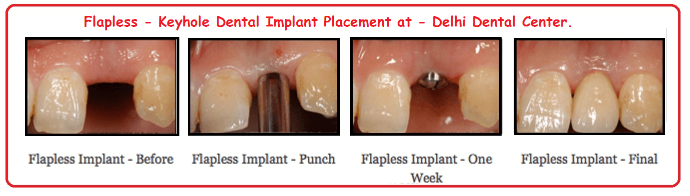Flapless Guided Painless Dental Implant Treatment In Delhi India