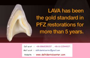 Porcelain Zirconia Ceramic CAD CAM Metal Free Dental Crown Treatment at Dental Crown Dentist Dental Clinic in Mayur Vihar East Delhi