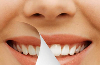 Tooth Whitening