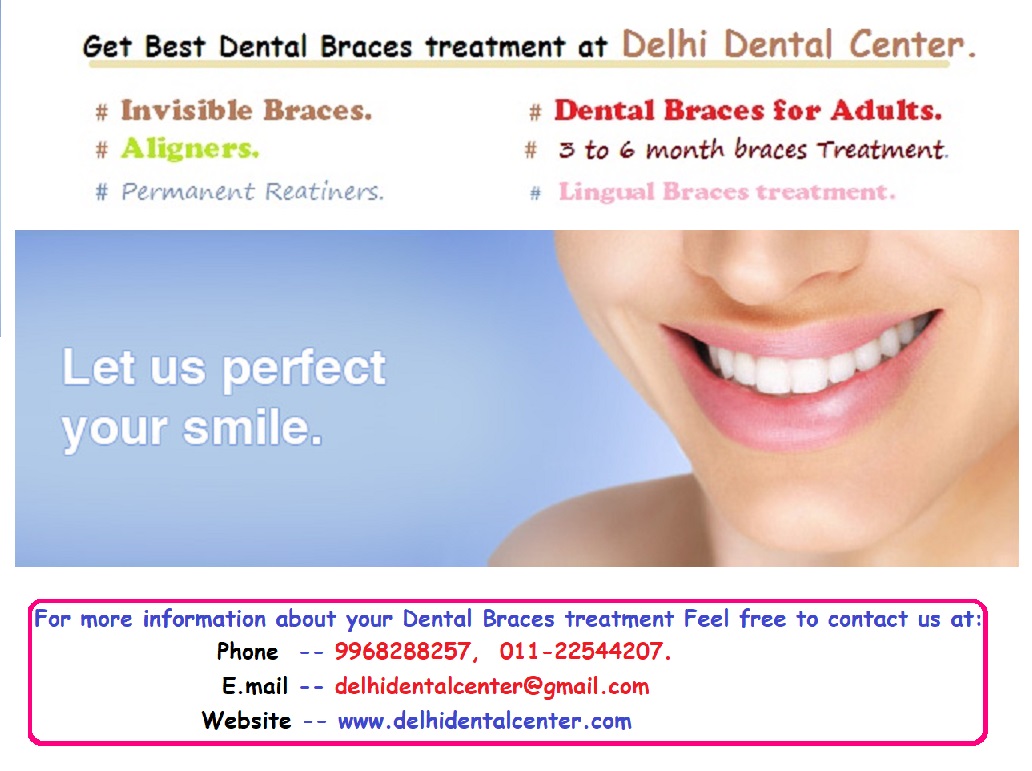 All on 4 Dental Implants in Laxmi Nagar