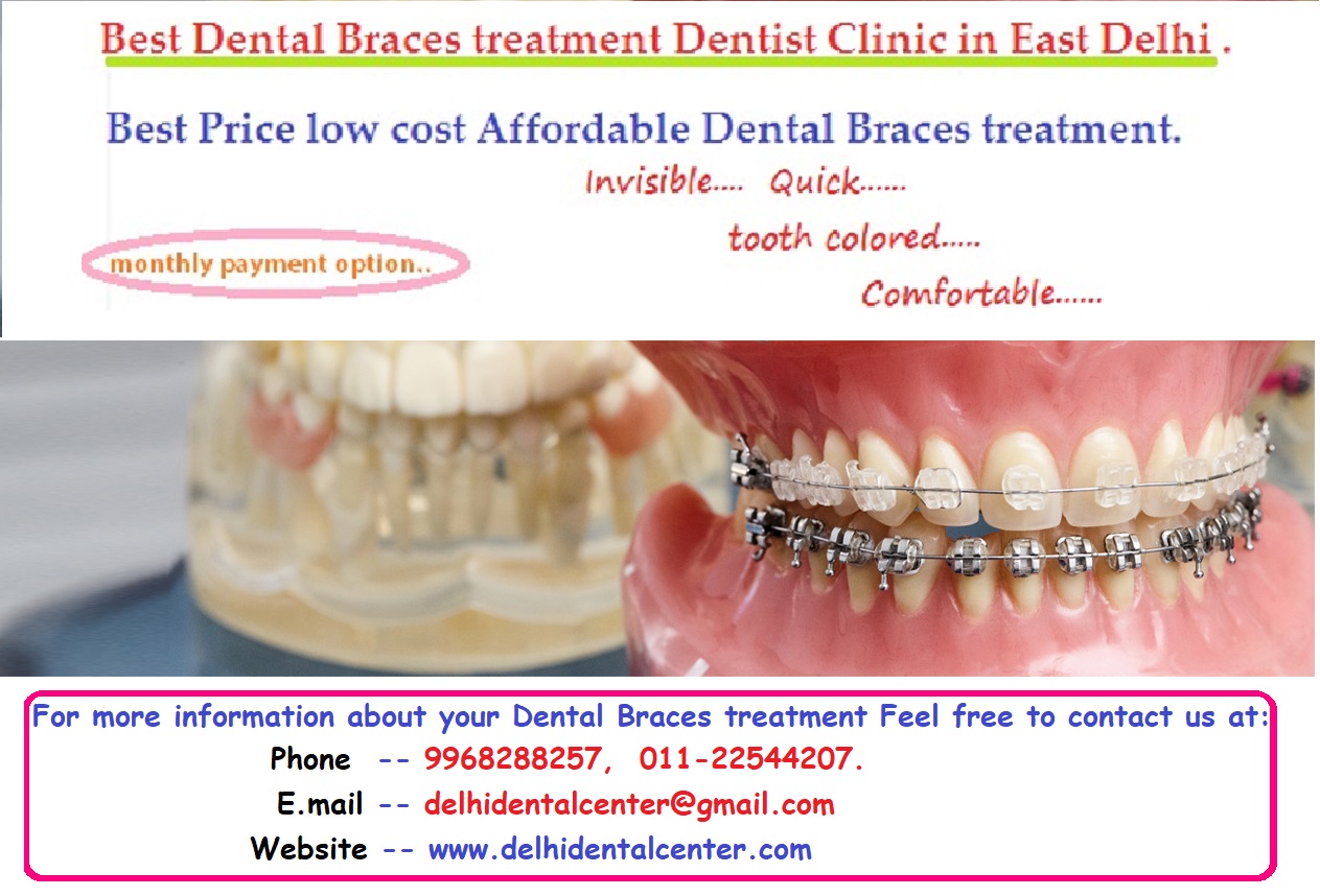 Dental Braces Clinic in Krishna Nagar.