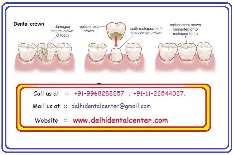 Porcelain Zirconia Ceramic CAD CAM Metal Free Dental Crowns, Teeth Cap Treatment at Dental Crown Dentist Dental Clinic in Pandav Nagar, East Delhi